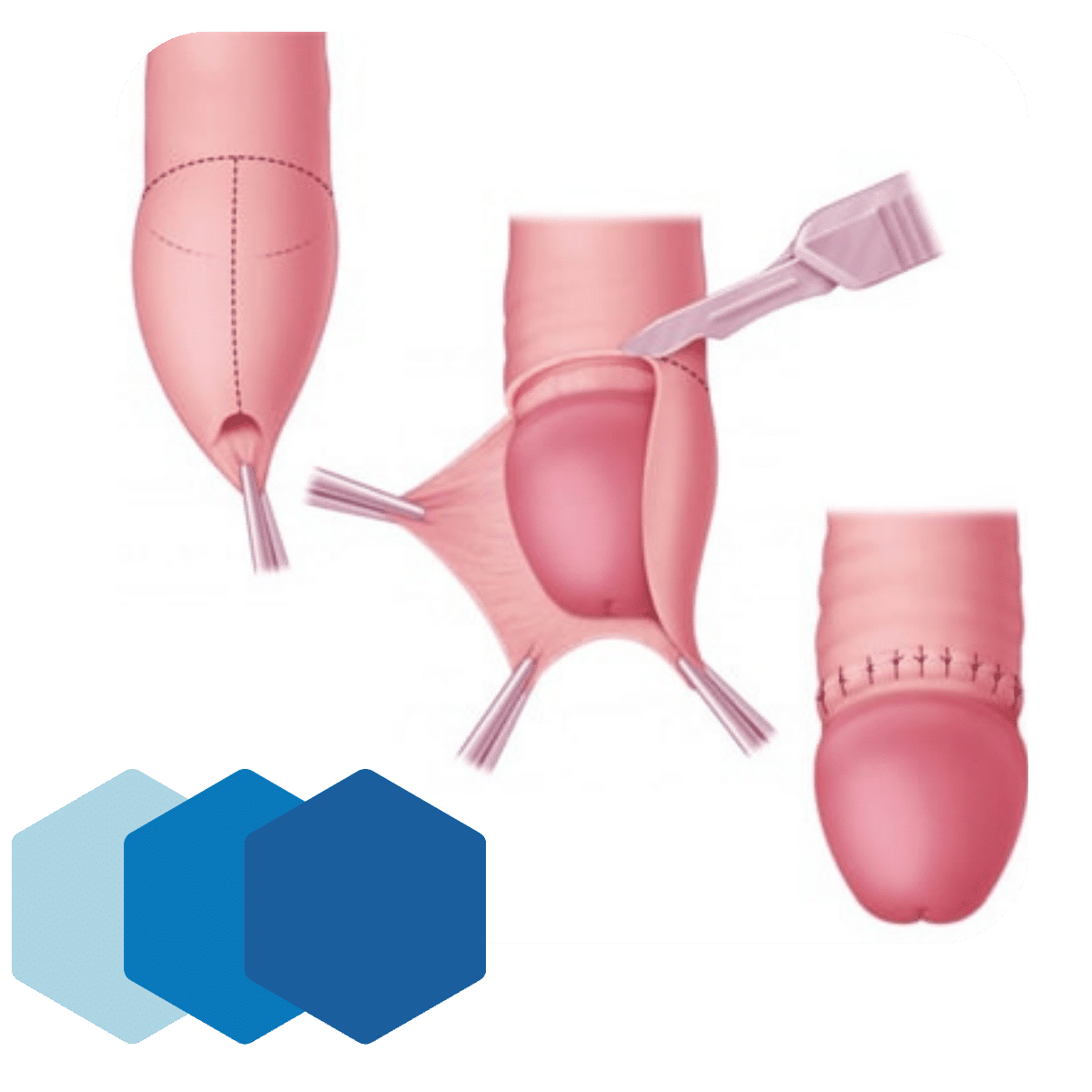 Procedimiento de circuición en Naucalpan Estado de México: pasos ambulatorios para retirar el prepucio con puntos finales